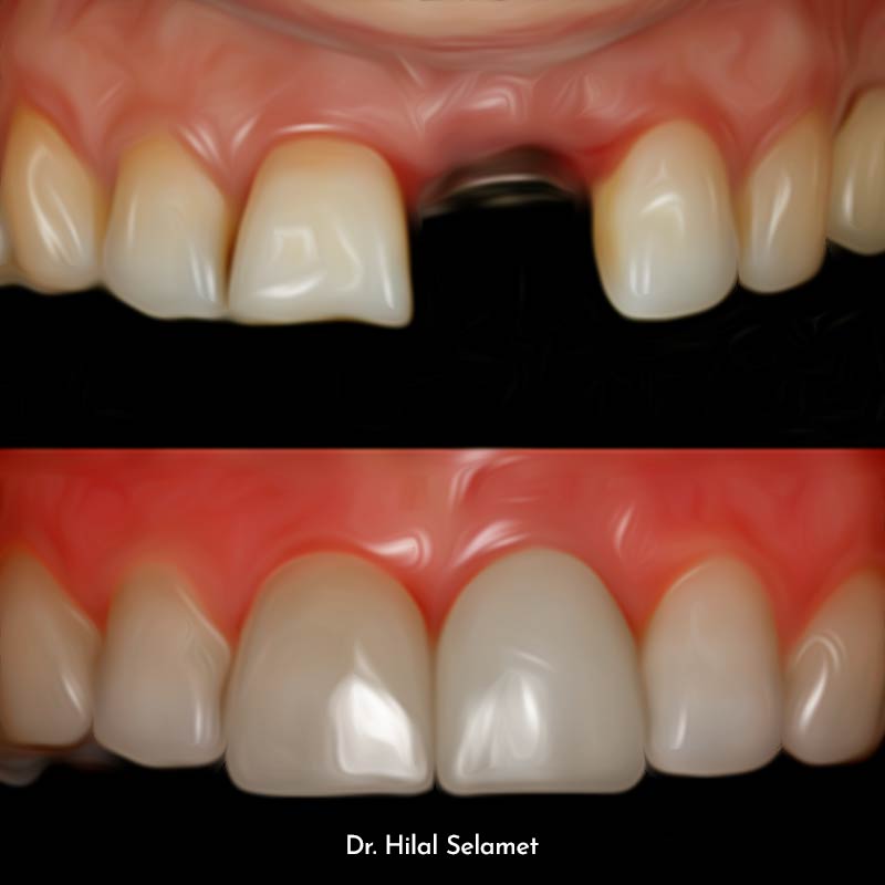 İmplant öncesi diş görünümü